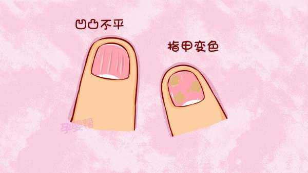 灰指甲有哪些前兆